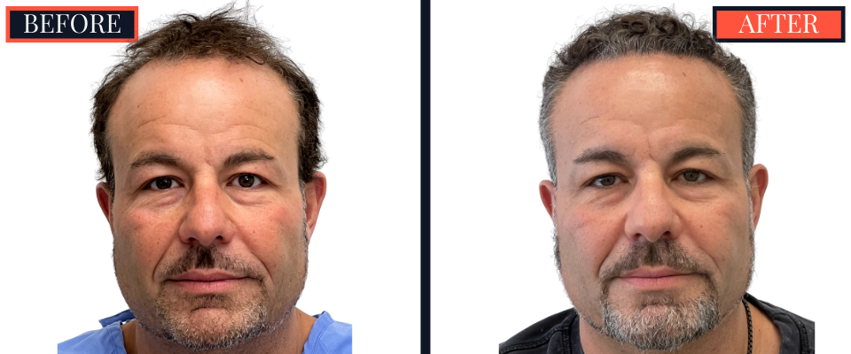 THTS 2872 G FUE BEFORE AND AFTER RESULTS