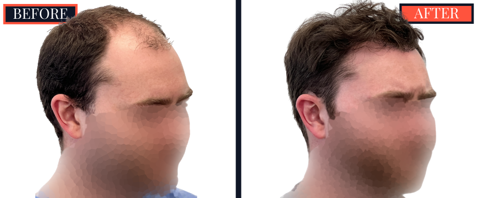 THTS 3001 GRAFT FUE RESULTS