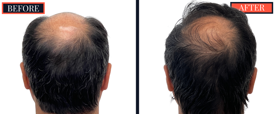 3078 GRAFT STRIP Hair Transplant - THTS RESULTS