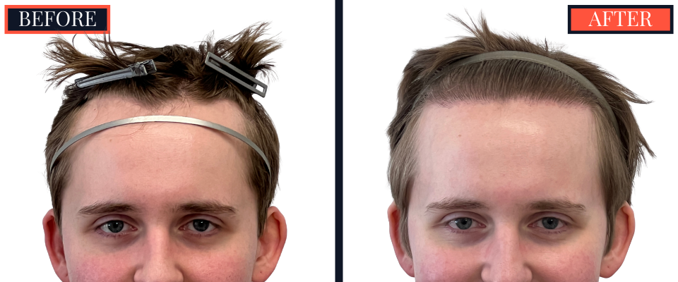 THTS Partial Shave - 753 GRAFT FUE - Results