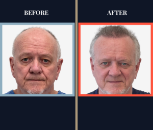 2444 GRAFT FUE HAIR TRANSPLANT RESULTS