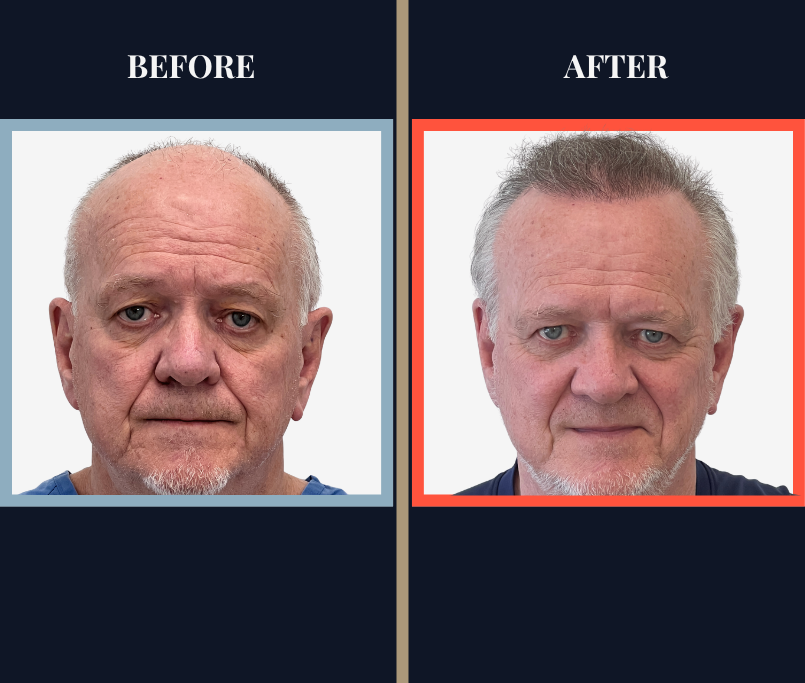 2444 GRAFT FUE HAIR TRANSPLANT RESULTS
