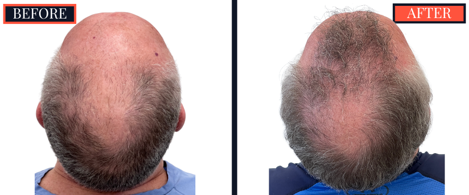 2444 GRAFT FUE HAIR TRANSPLANT RESULTS