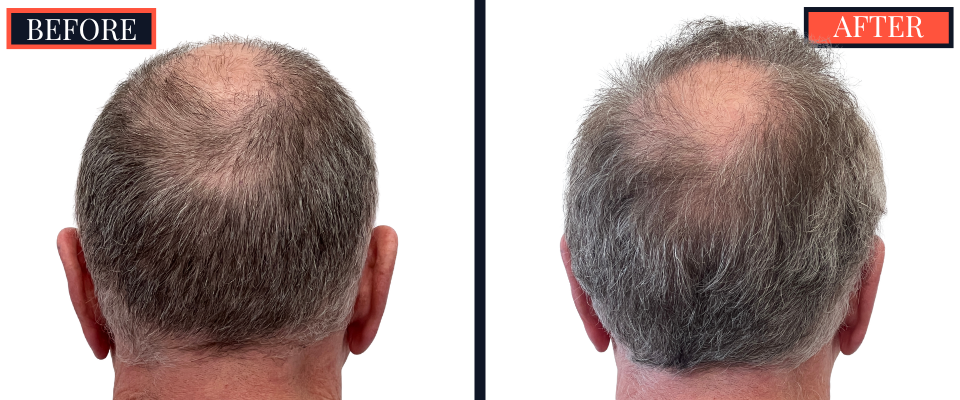 2444 GRAFT FUE HAIR TRANSPLANT RESULTS