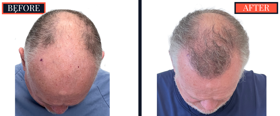 2444 GRAFT FUE HAIR TRANSPLANT RESULTS