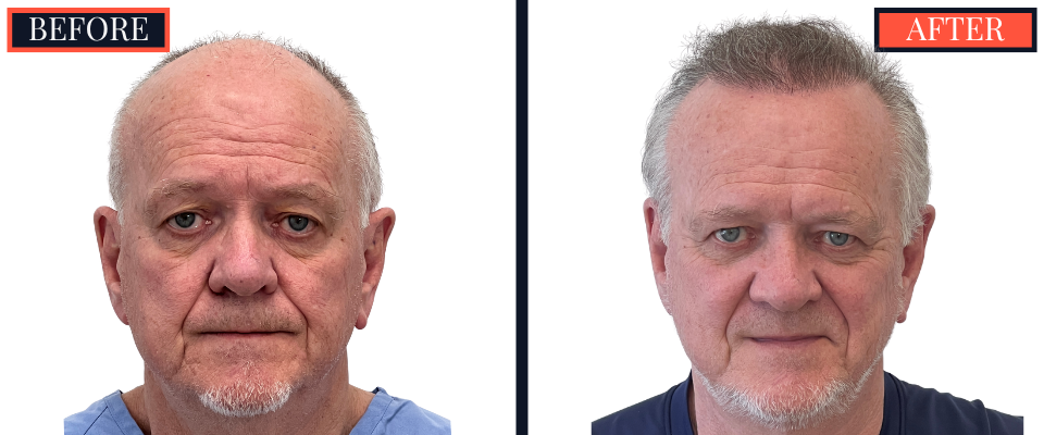 2444 GRAFT FUE HAIR TRANSPLANT RESULTS