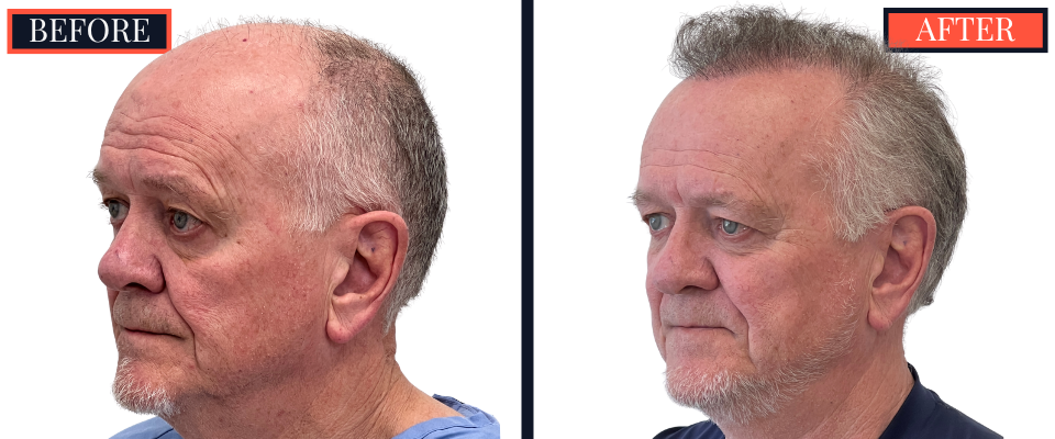2444 GRAFT FUE HAIR TRANSPLANT RESULTS