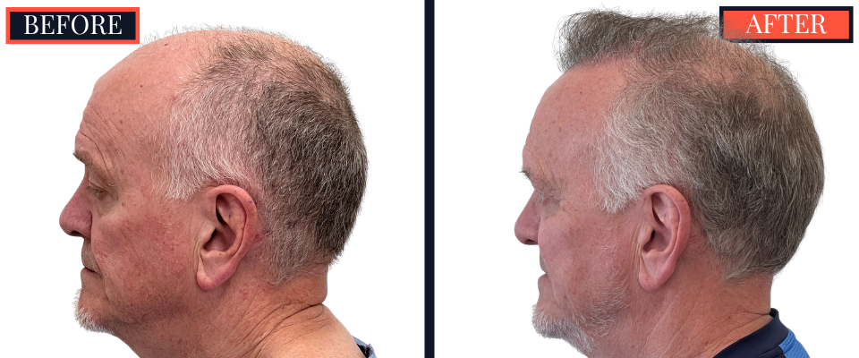 2444 GRAFT FUE HAIR TRANSPLANT RESULTS