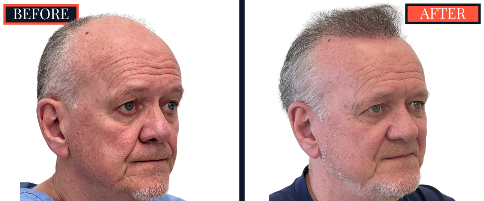 2444 GRAFT FUE HAIR TRANSPLANT RESULTS