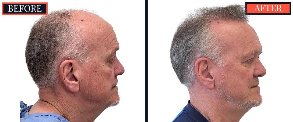 2444 GRAFT FUE HAIR TRANSPLANT RESULTS