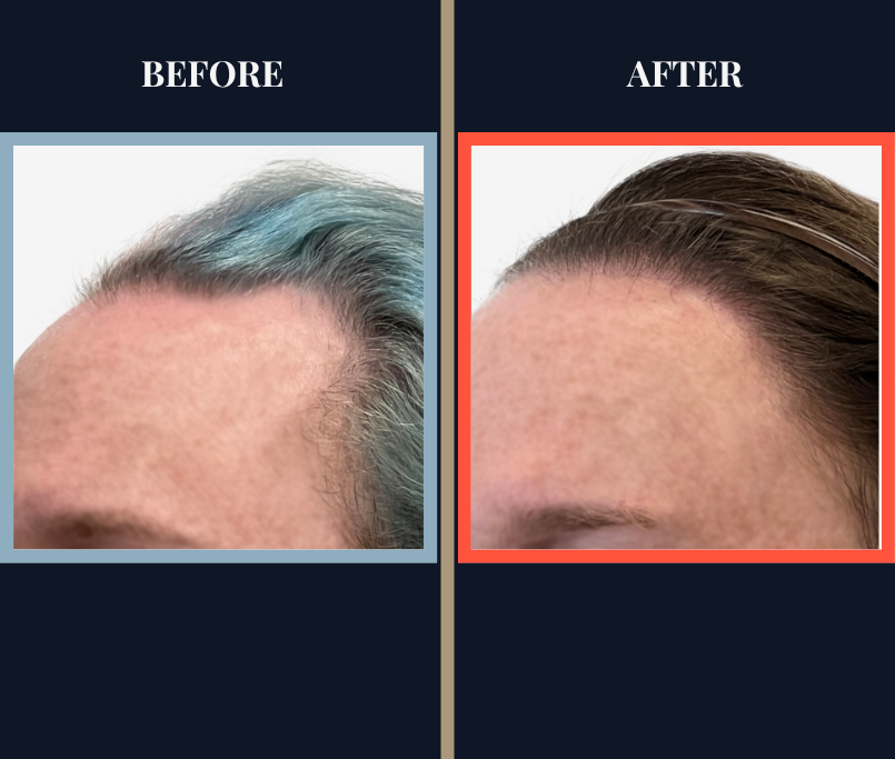 1810 GRAFT FUE HAIR TRANSPLANT RESULTS
