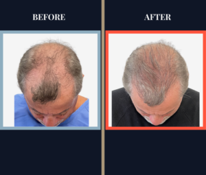 Before and After 3247 Graft FUT Strip Hair Transplant