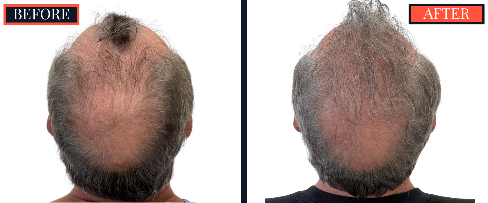 Before and After 3247 Graft FUT Strip Hair Transplant Results