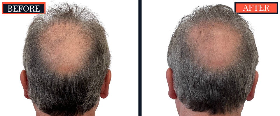 Before and After 3247 Graft FUT Strip Hair Transplant Results