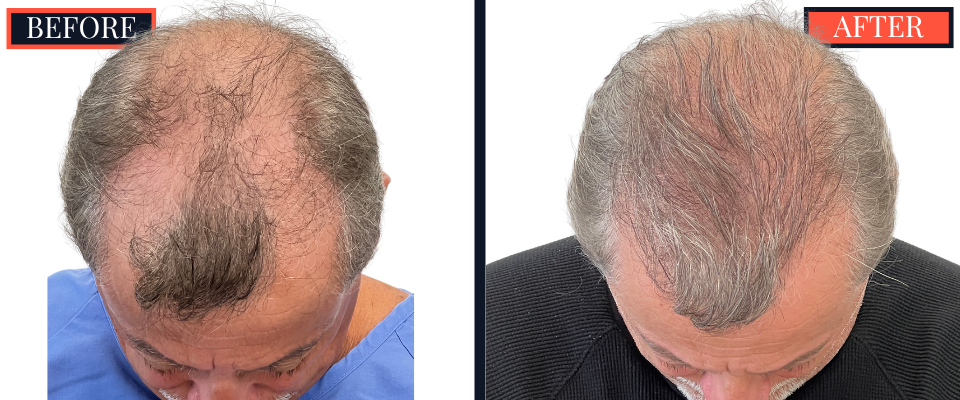 Before and After 3247 Graft FUT Strip Hair Transplant Results