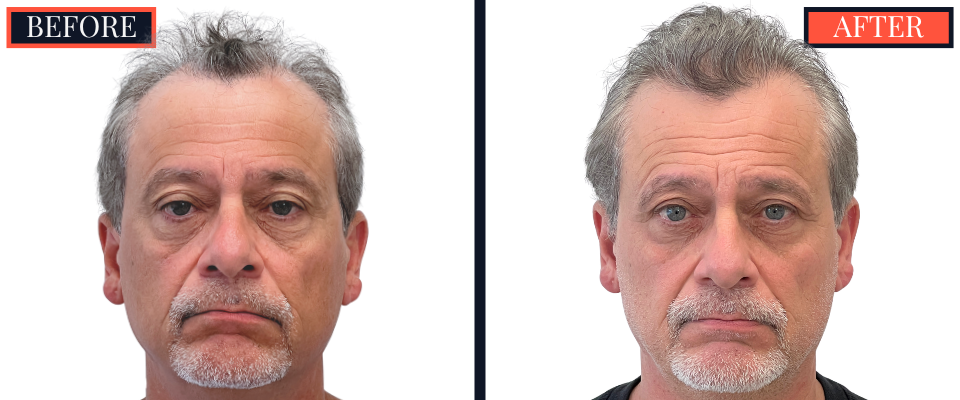 Before and After 3247 Graft FUT Strip Hair Transplant Results