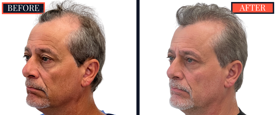 Before and After 3247 Graft FUT Strip Hair Transplant Results