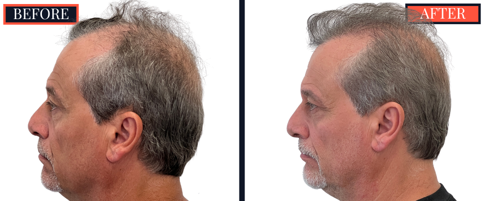 Before and After 3247 Graft FUT Strip Hair Transplant Results