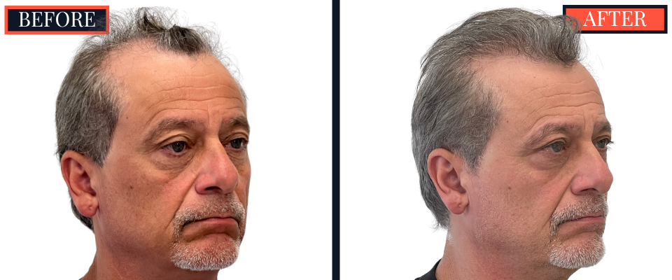 Before and After 3247 Graft FUT Strip Hair Transplant Results