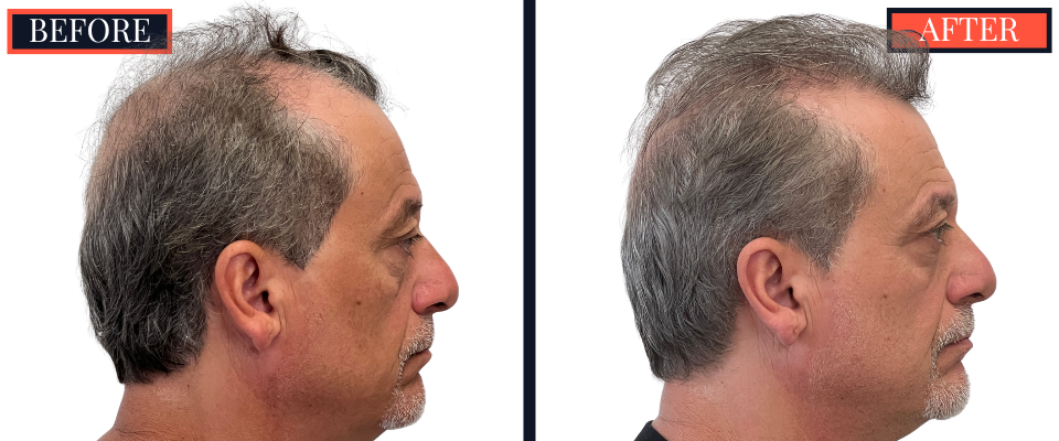 Before and After 3247 Graft FUT Strip Hair Transplant Results