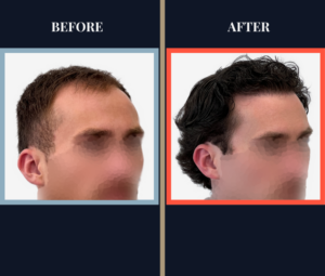 2408 GRAFT FUE HAIR TRANSPLANT SURGERY BEFORE AND AFTER PHOTO