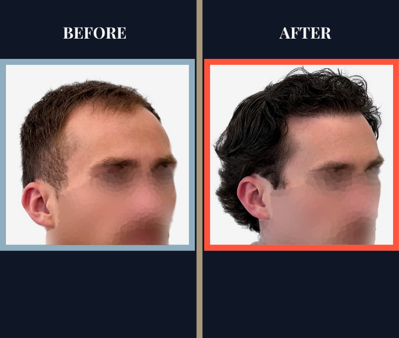 2408 GRAFT FUE HAIR TRANSPLANT SURGERY BEFORE AND AFTER PHOTO