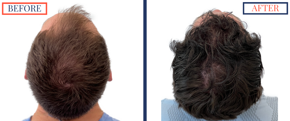 2408 GRAFT FUE HAIR TRANSPLANT SURGERY - BEFORE AND AFTER PHOTO