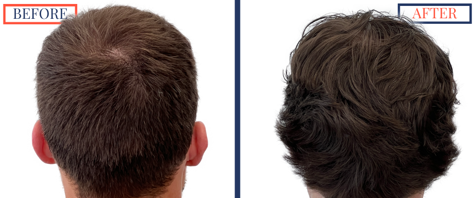2408 GRAFT FUE HAIR TRANSPLANT SURGERY - BEFORE AND AFTER PHOTO