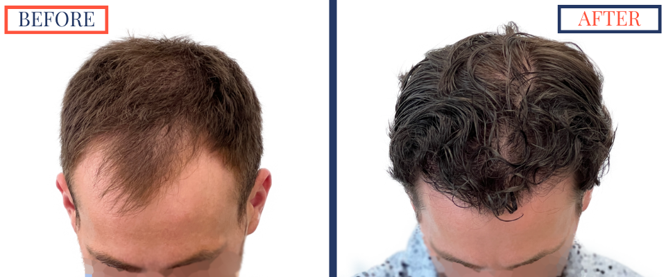 2408 GRAFT FUE HAIR TRANSPLANT SURGERY - BEFORE AND AFTER PHOTO