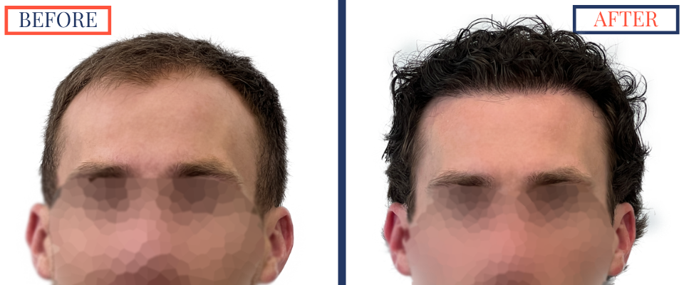 2408 GRAFT FUE HAIR TRANSPLANT SURGERY - BEFORE AND AFTER PHOTO