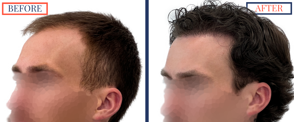 2408 GRAFT FUE HAIR TRANSPLANT SURGERY - BEFORE AND AFTER PHOTO