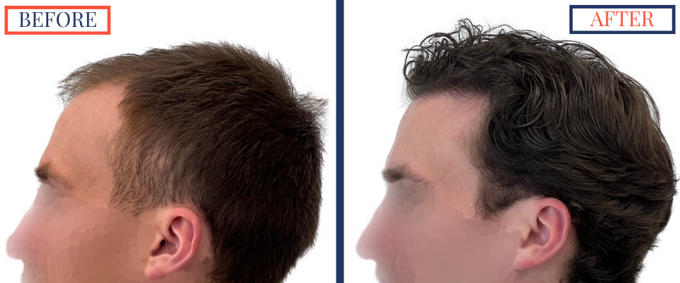2408 GRAFT FUE HAIR TRANSPLANT SURGERY - BEFORE AND AFTER PHOTO