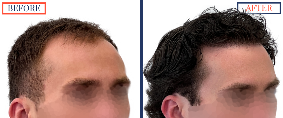 2408 GRAFT FUE HAIR TRANSPLANT SURGERY - BEFORE AND AFTER PHOTO