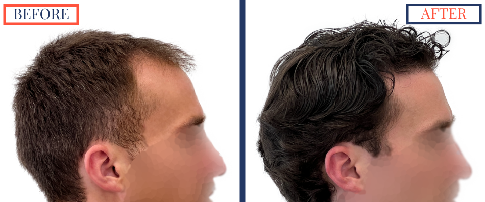 2408 GRAFT FUE HAIR TRANSPLANT SURGERY - BEFORE AND AFTER PHOTO