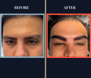 Eyebrow FUT Hair Transplant
