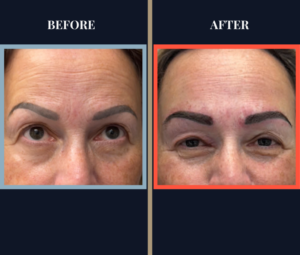 Eyebrow Hair Transplant