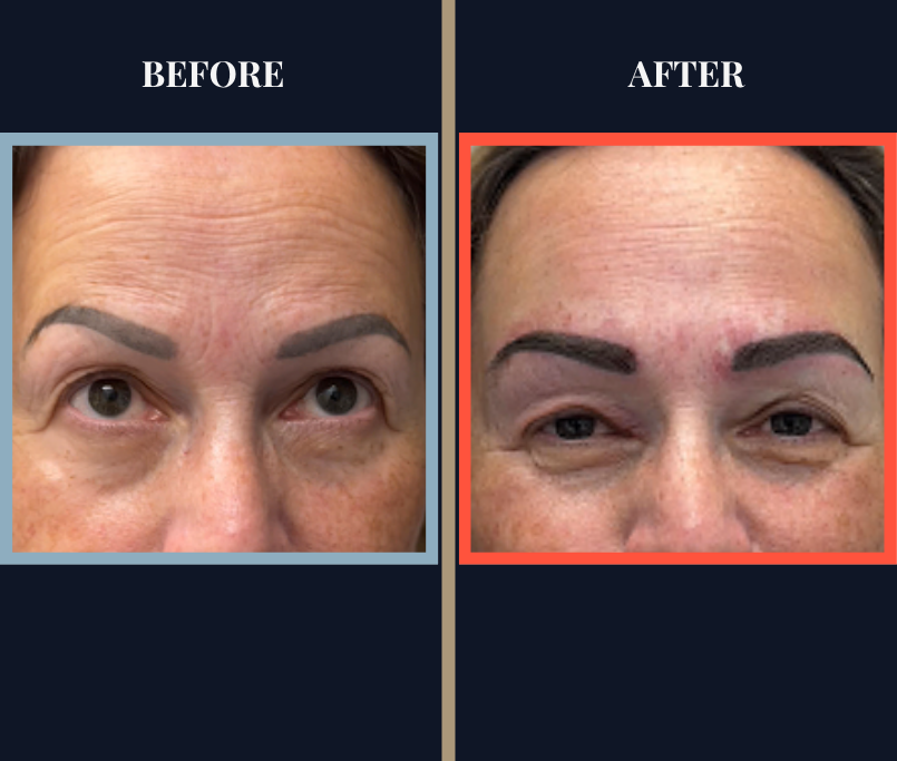 Eyebrow Hair Transplant