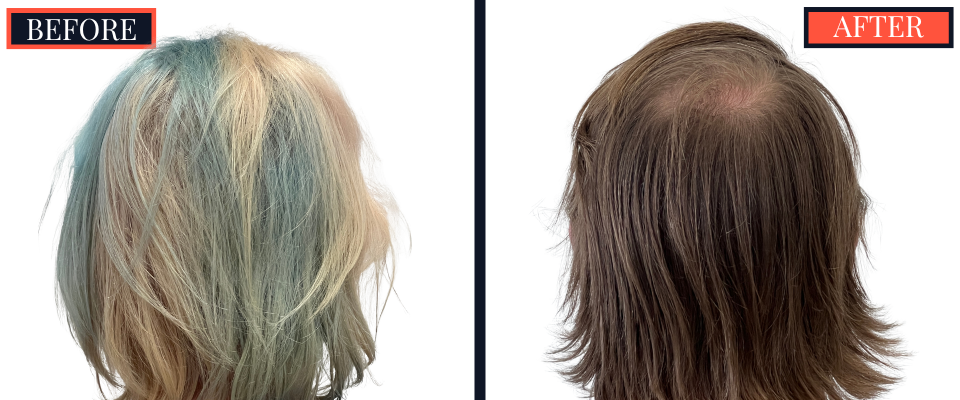 1810 GRAFT FUE HAIR TRANSPLANT RESULTS