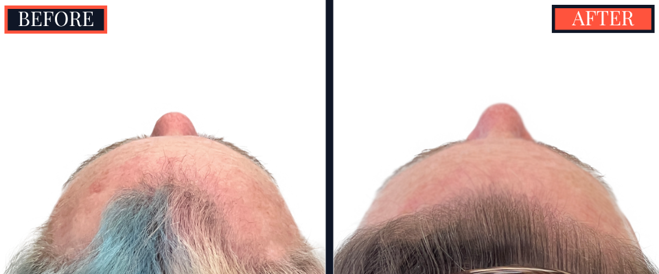 1810 GRAFT FUE HAIR TRANSPLANT RESULTS