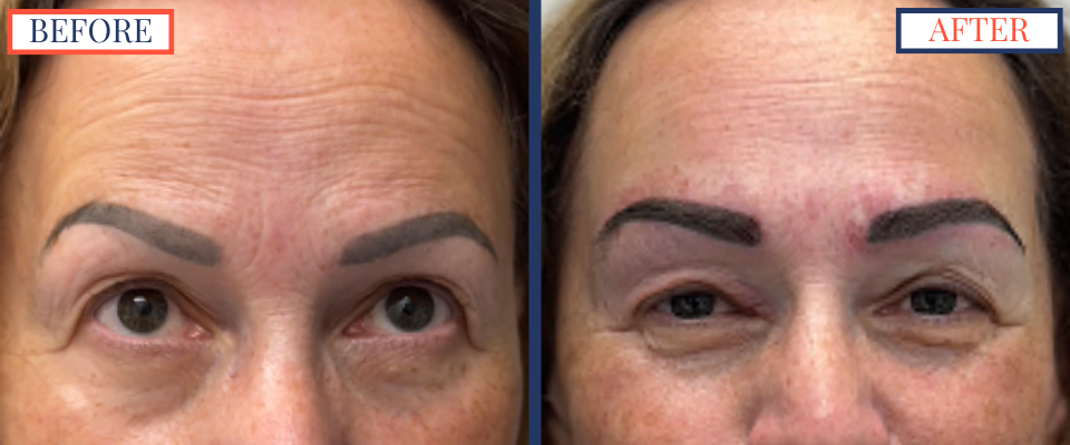 Eyebrow Hair Transplant Before and After Surgery