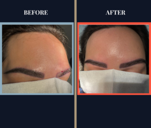750 graft Eyebrow FUT hair transplant