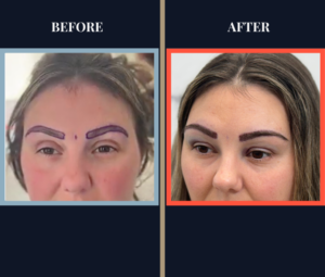 Eyebrow FUE Hair Transplant Surgery