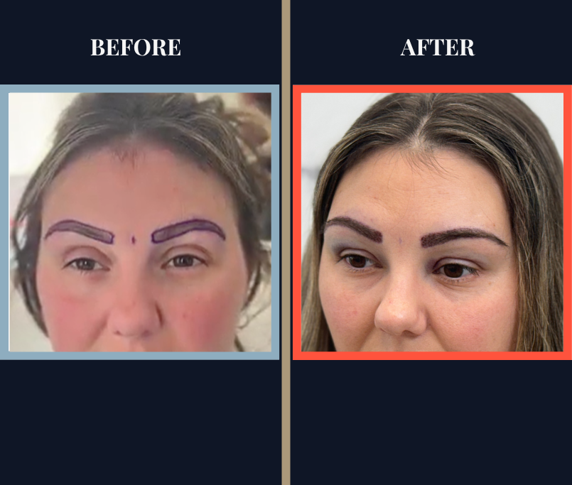 Eyebrow FUE Hair Transplant Surgery