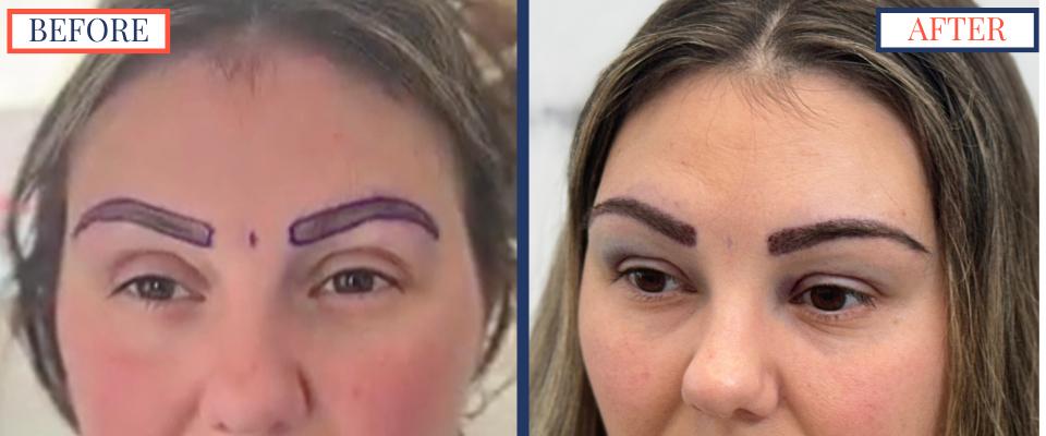 Eyebrow FUE Hair Transplant Surgery surgery photos
