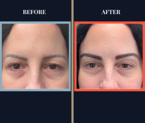 Eyebrow FUT Hair Tranplant before and after photo