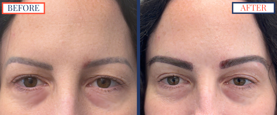 Eyebrow FUT Hair Transplant Before and After Surgery photo