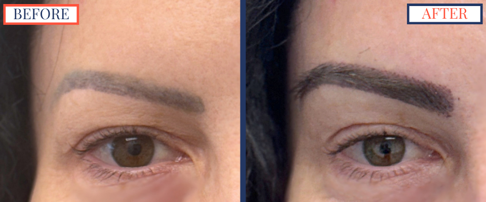 Eyebrow FUT Hair Transplant Before and After Surgery photo Left Brow zoom