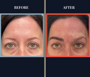 Eyebrow FUT Hair Transplant Before and After Surgery photo
