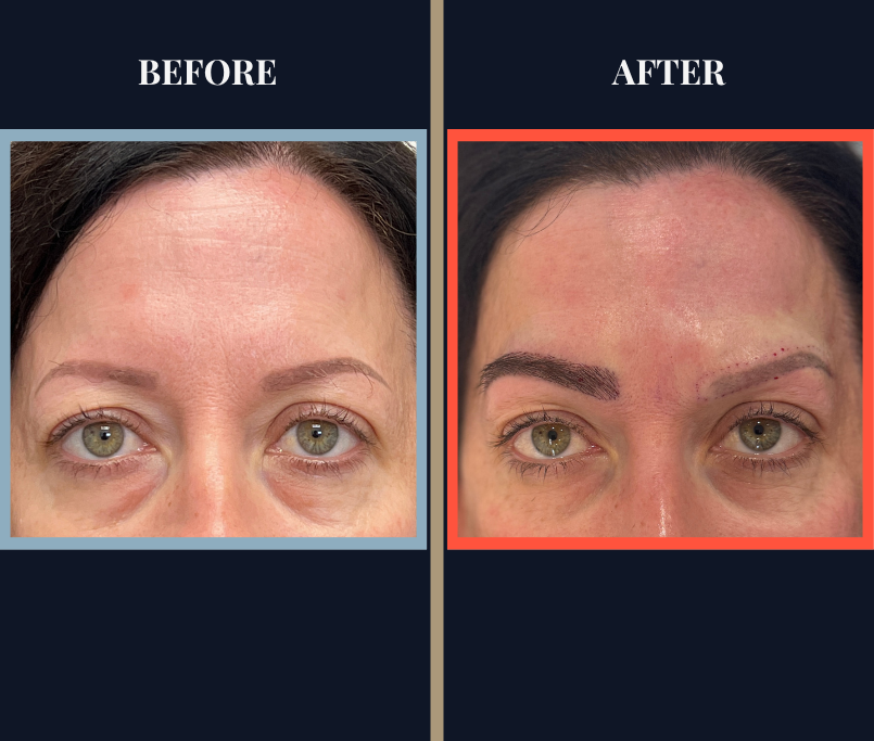 Eyebrow FUT Hair Transplant Before and After Surgery photo