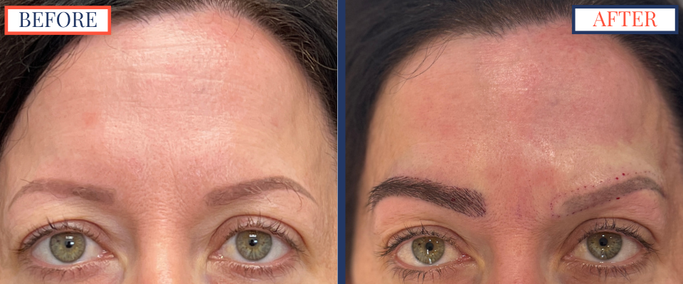 Eyebrow FUT Hair Transplant Surgery photos